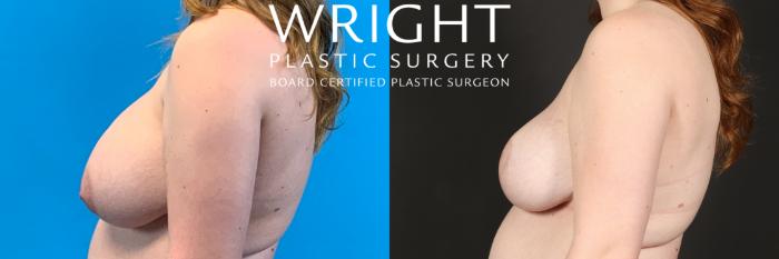 Before & After Breast Lift Case 433 Left Side View in Little Rock, Arkansas