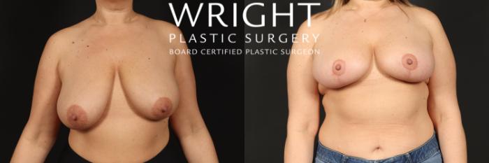 Before & After Breast Lift Case 434 Front View in Little Rock, Arkansas
