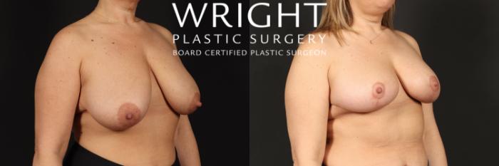 Before & After Breast Lift Case 434 Right Oblique View in Little Rock, Arkansas