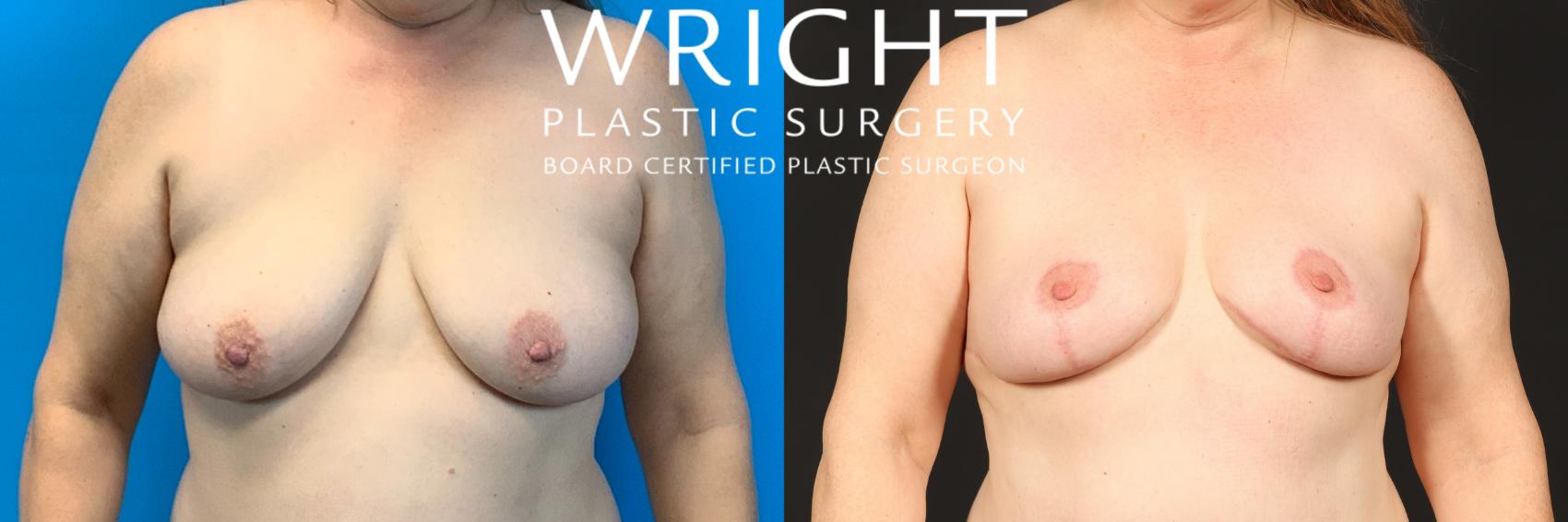 Before & After Breast Lift Case 437 Front View in Little Rock, Arkansas