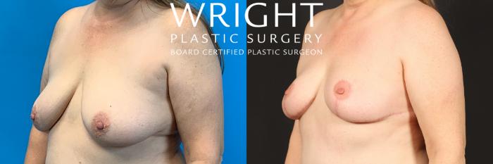 Before & After Breast Lift Case 437 Left Oblique View in Little Rock, Arkansas