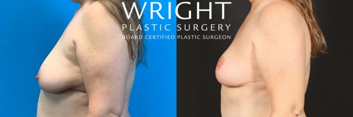 Before & After Breast Lift Case 437 Left Side View in Little Rock, Arkansas