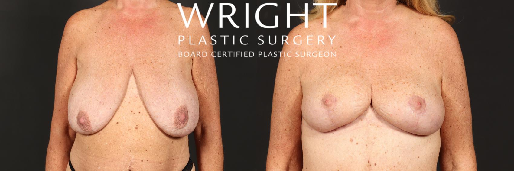 Before & After Breast Lift Case 457 Front View in Little Rock, Arkansas