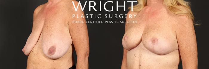 Before & After Breast Lift Case 457 Left Oblique View in Little Rock, Arkansas