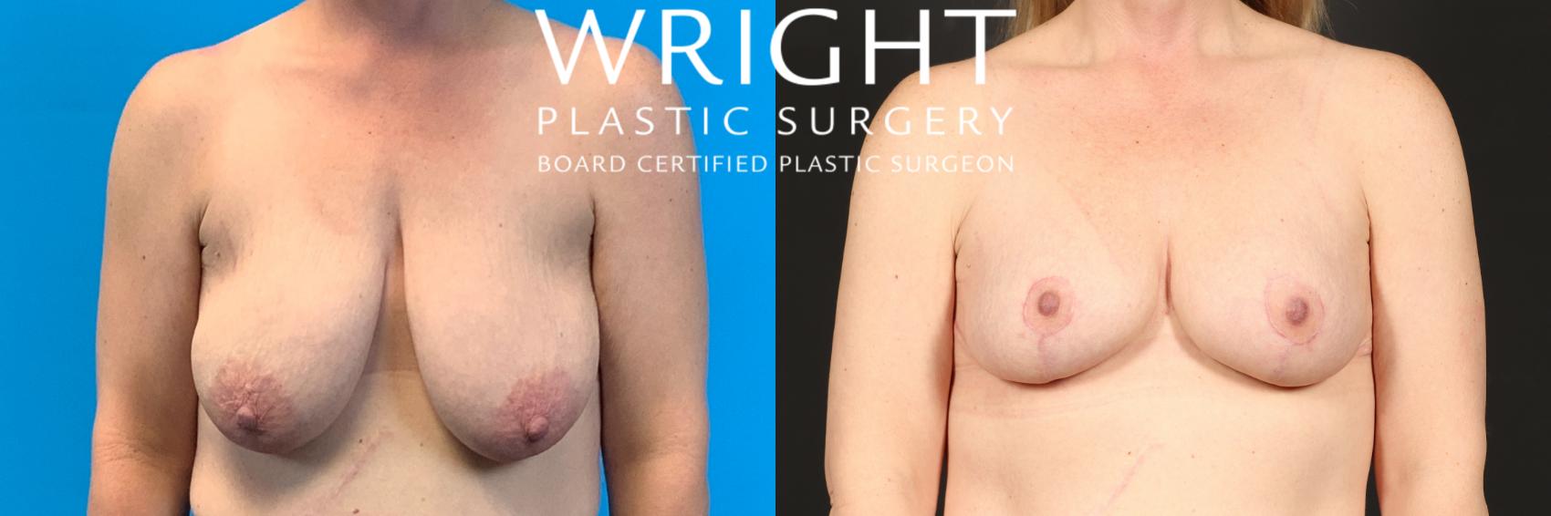 Before & After Breast Lift Case 460 Front View in Little Rock, Arkansas