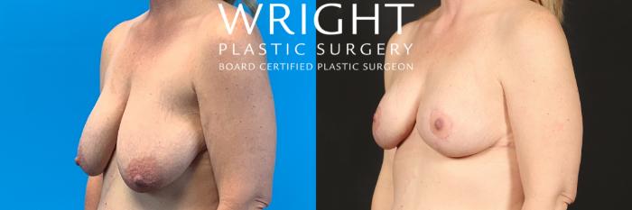 Before & After Breast Lift Case 460 Left Oblique View in Little Rock, Arkansas