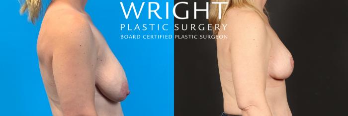Before & After Breast Lift Case 460 Right Side View in Little Rock, Arkansas