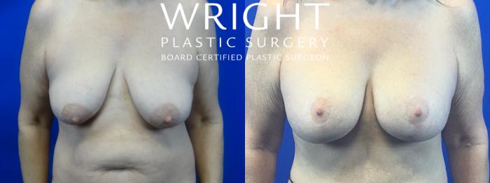 Before & After Breast Lift Case 48 Front View in Little Rock, Arkansas