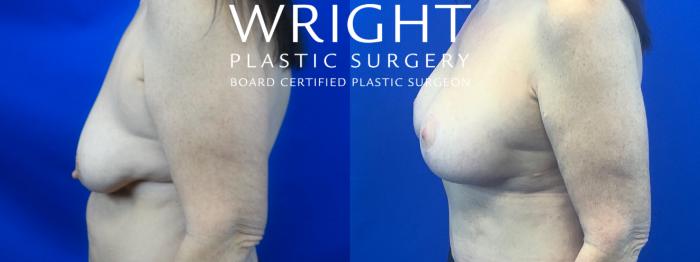 Before & After Breast Lift Case 48 Left Side View in Little Rock, Arkansas