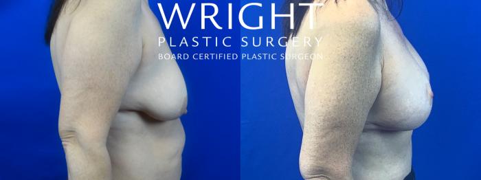 Before & After Breast Augmentation Case 48 Right Side View in Little Rock, Arkansas