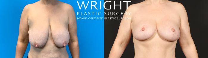 Before & After Breast Lift Case 488 Front View in Little Rock, Arkansas