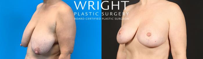 Before & After Breast Lift Case 488 Left Oblique View in Little Rock, Arkansas