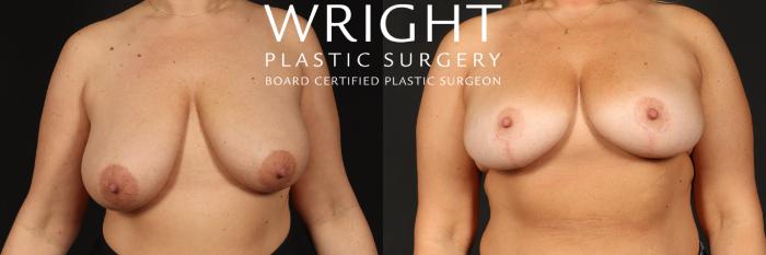 Before & After Breast Lift Case 504 Front View in Little Rock, Arkansas