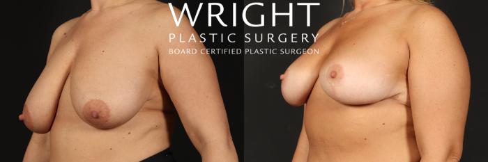 Before & After Breast Lift Case 504 Left Oblique View in Little Rock, Arkansas