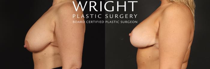 Before & After Breast Lift Case 504 Left Side View in Little Rock, Arkansas