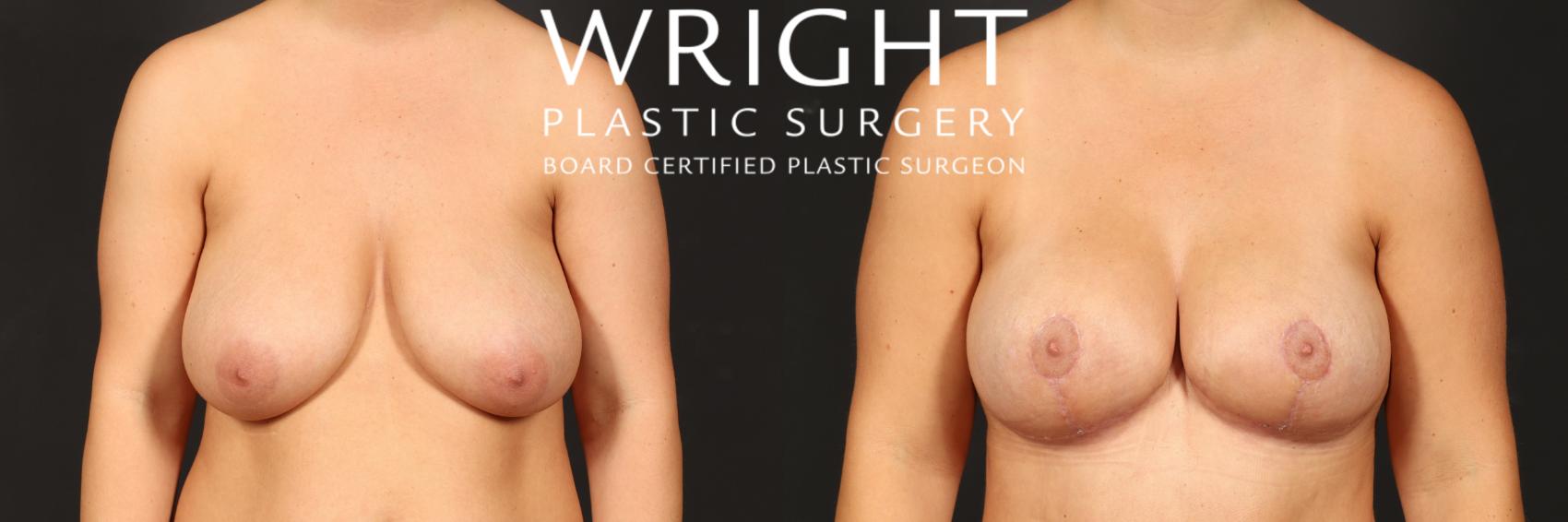 Before & After Breast Lift Case 516 Front View in Little Rock, Arkansas