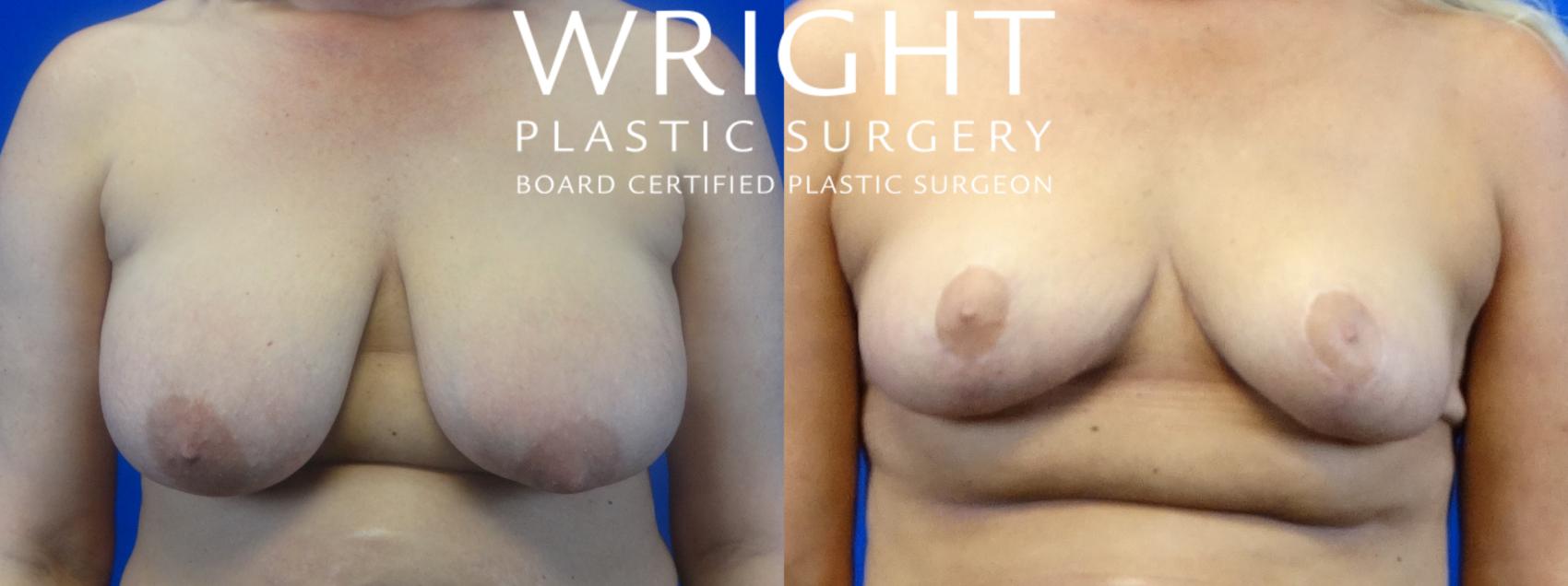 Before & After Breast Lift Case 52 Front View in Little Rock, Arkansas