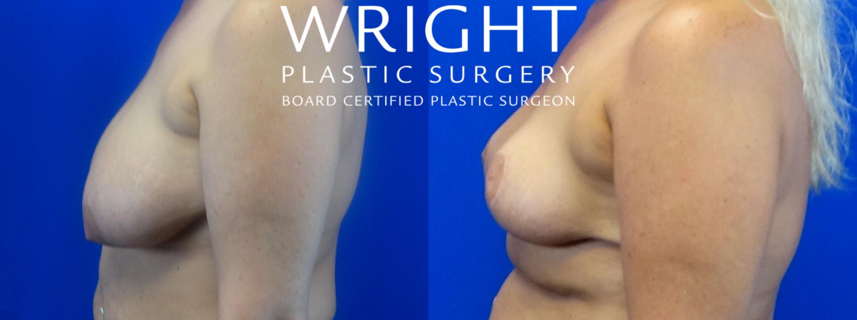 Before & After Breast Lift Case 52 Left Side View in Little Rock, Arkansas