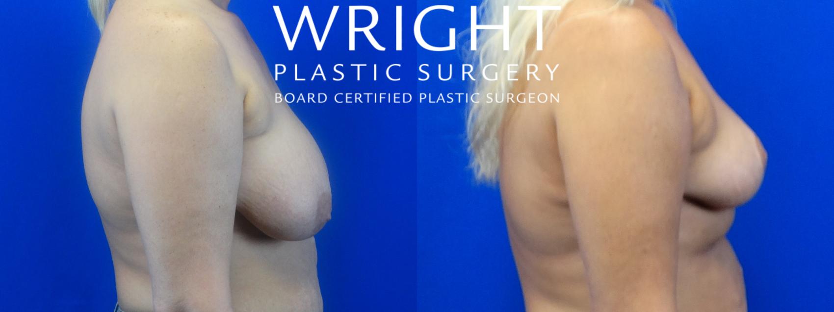 Before & After Breast Lift Case 52 Right Side View in Little Rock, Arkansas