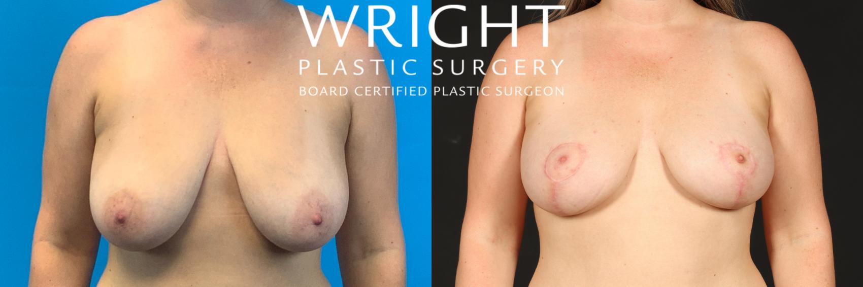 Before & After Breast Lift Case 542 Front View in Little Rock, Arkansas