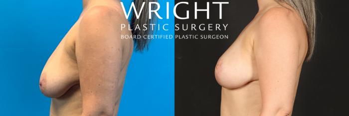 Before & After Breast Lift Case 542 Left Side View in Little Rock, Arkansas