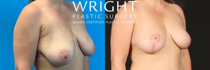 Before & After Breast Lift Case 542 Right Oblique View in Little Rock, Arkansas