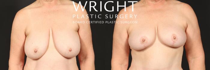 Before & After Breast Lift Case 570 Front View in Little Rock, Arkansas