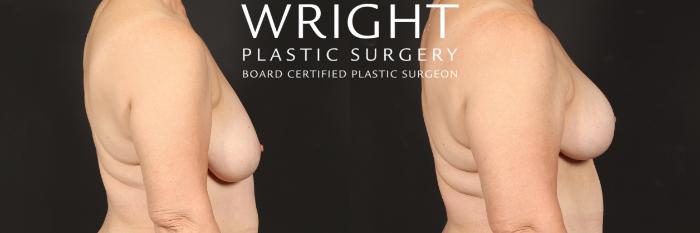 Before & After Breast Lift Case 570 Right Side View in Little Rock, Arkansas