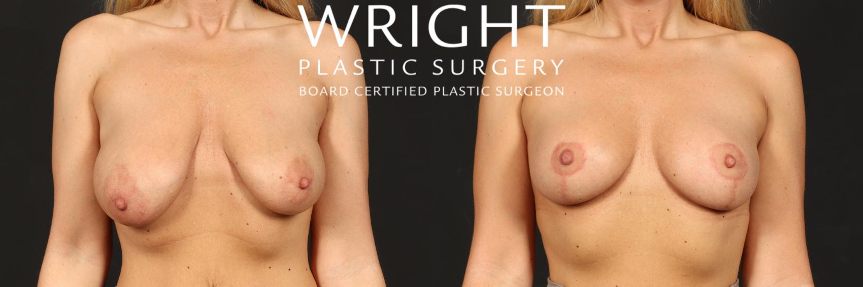 Before & After Breast Lift Case 571 Front View in Little Rock, Arkansas