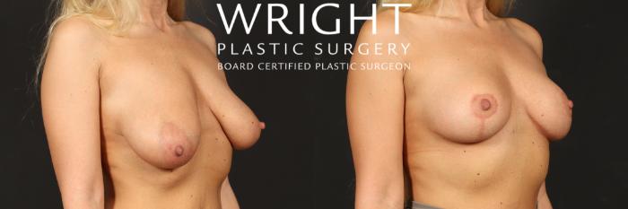 Before & After Breast Lift Case 571 Right Oblique View in Little Rock, Arkansas