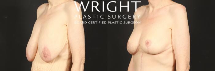 Before & After Breast Lift Case 573 Left Oblique View in Little Rock, Arkansas