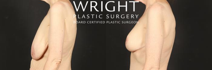 Before & After Breast Lift Case 573 Left Side View in Little Rock, Arkansas