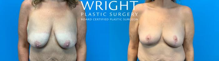 Before & After Breast Lift Case 700 Front View in Little Rock, Arkansas