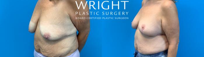Before & After Breast Lift Case 700 Left Oblique View in Little Rock, Arkansas