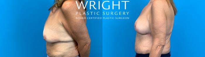 Before & After Breast Lift Case 700 Left Side View in Little Rock, Arkansas