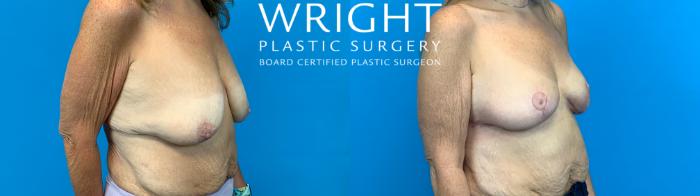 Before & After Breast Lift Case 700 Right Oblique View in Little Rock, Arkansas