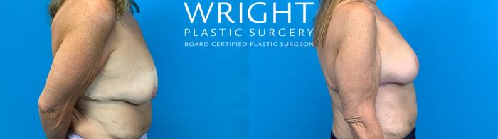 Before & After Breast Lift Case 700 Right Side View in Little Rock, Arkansas