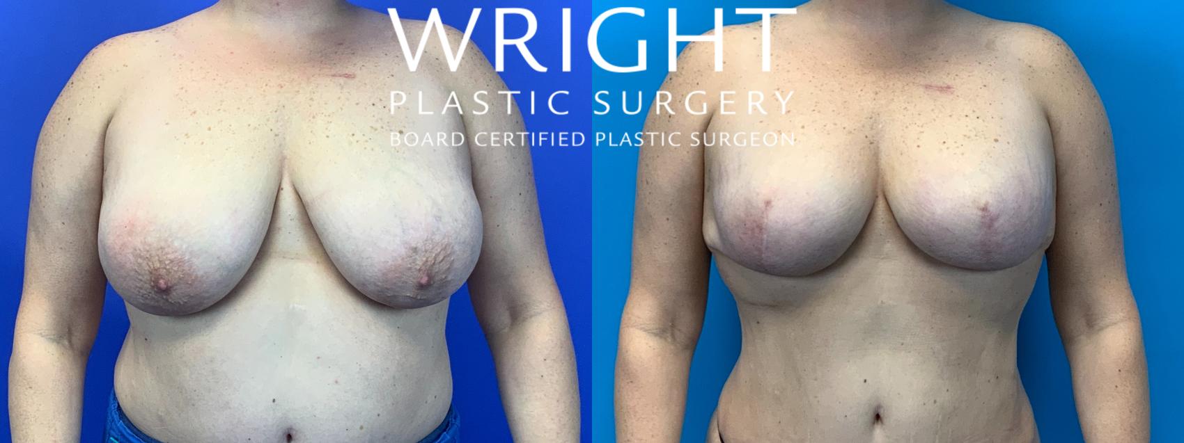 Before & After Breast Reconstruction Case 151 Front View in Little Rock, Arkansas