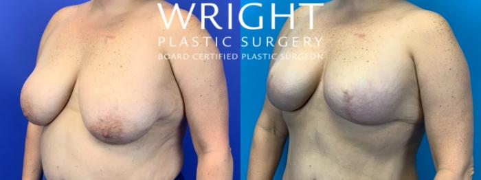 Before & After Breast Reconstruction Case 151 Left Oblique View in Little Rock, Arkansas