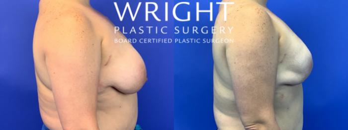 Before & After Breast Reconstruction Case 151 Right Side View in Little Rock, Arkansas