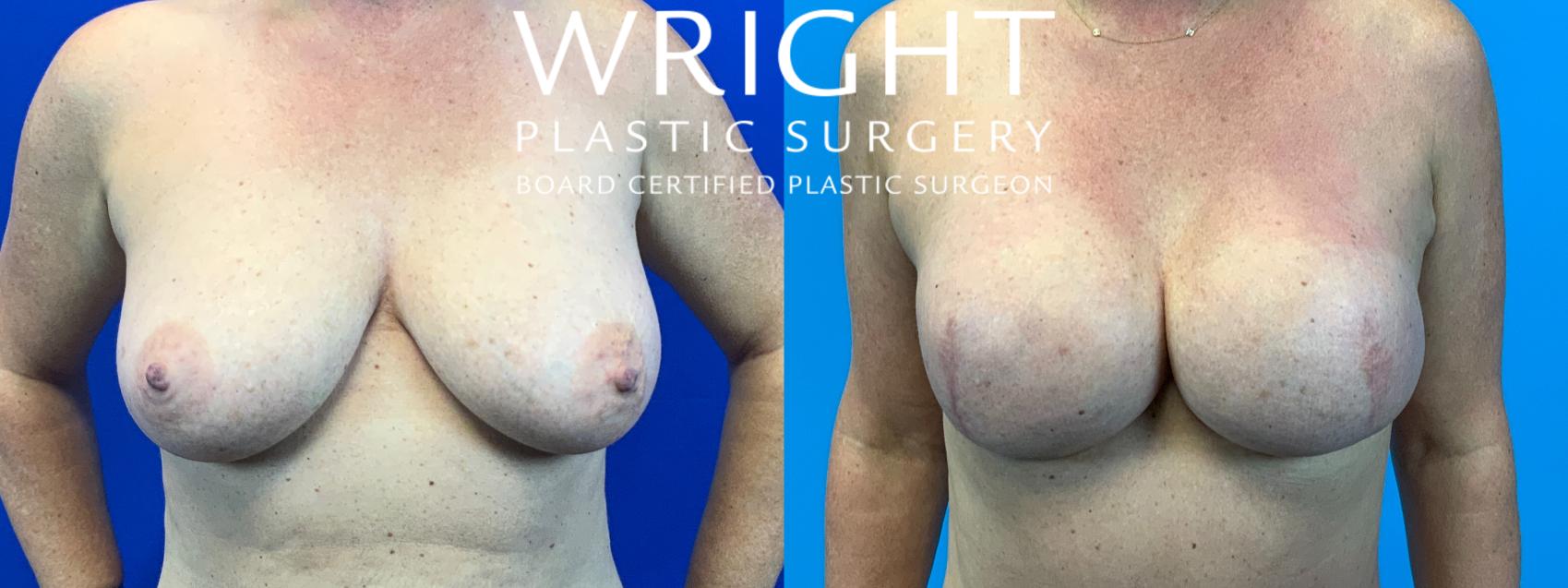 Before & After Breast Reconstruction Case 152 Front View in Little Rock, Arkansas