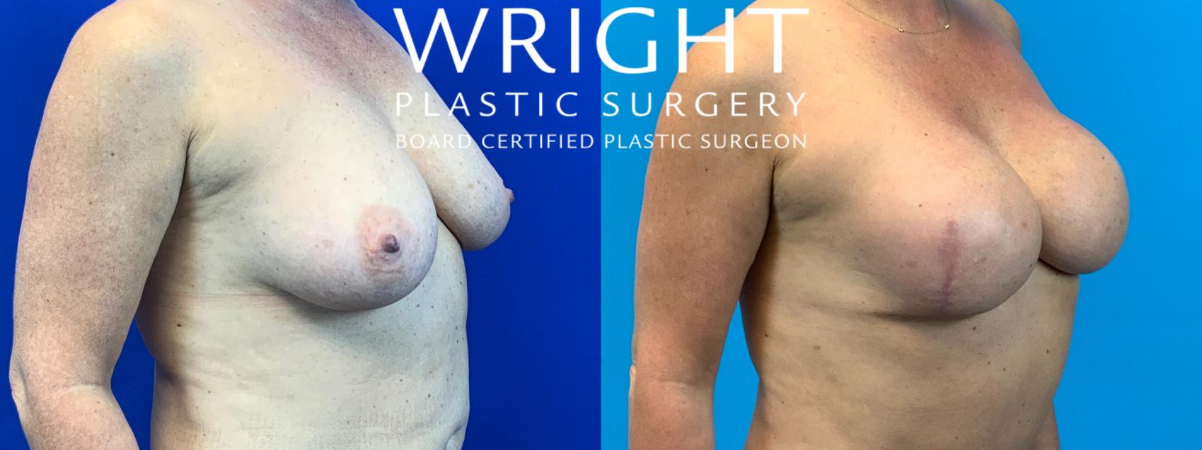 Before & After Breast Reconstruction Case 152 Right Oblique View in Little Rock, Arkansas