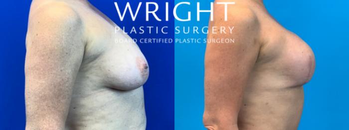 Before & After Breast Reconstruction Case 152 Right Side View in Little Rock, Arkansas