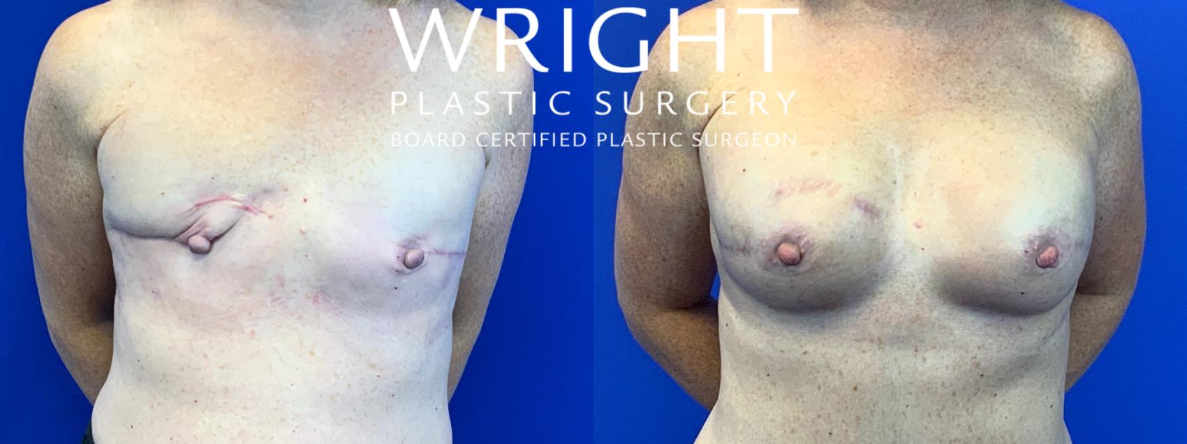 Before & After Breast Reconstruction Case 161 Front View in Little Rock, Arkansas