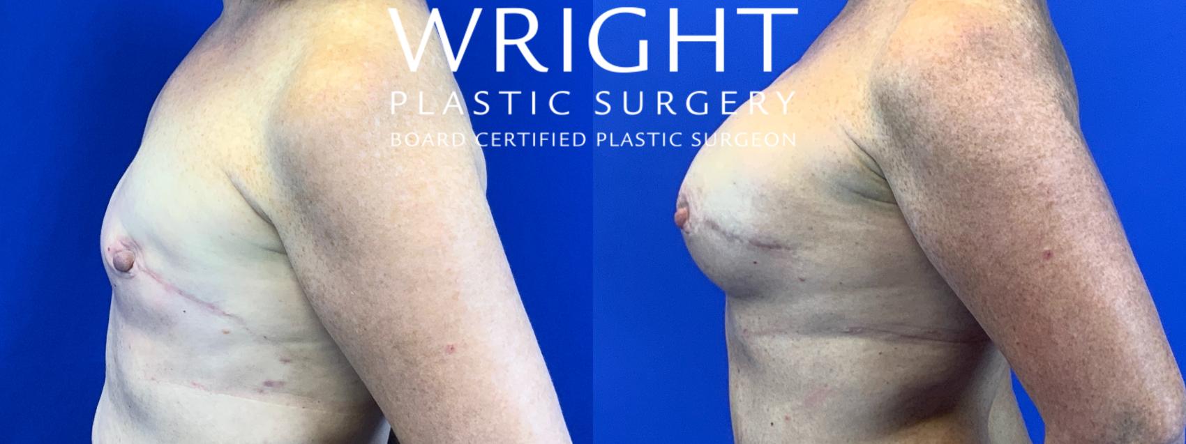 Before & After Breast Reconstruction Case 161 Left Side View in Little Rock, Arkansas