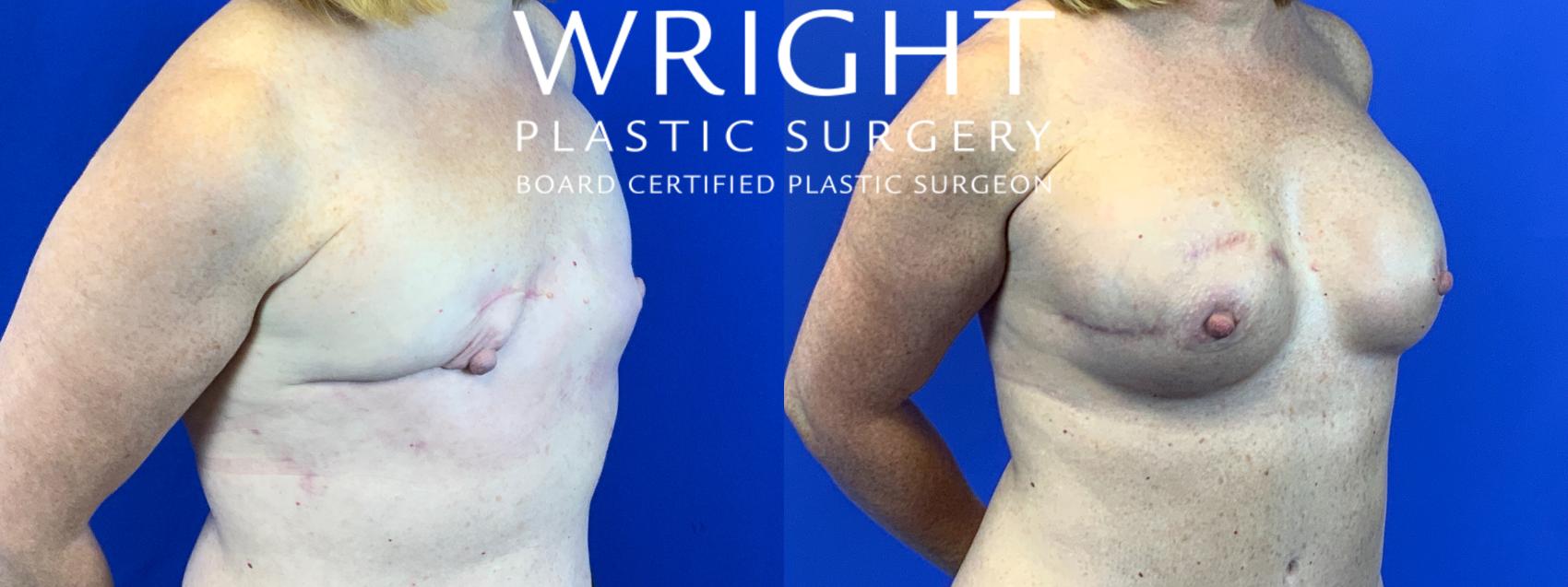 Before & After Breast Reconstruction Case 161 Right Oblique View in Little Rock, Arkansas