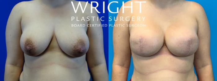Before & After Breast Reconstruction Case 184 Front View in Little Rock, Arkansas