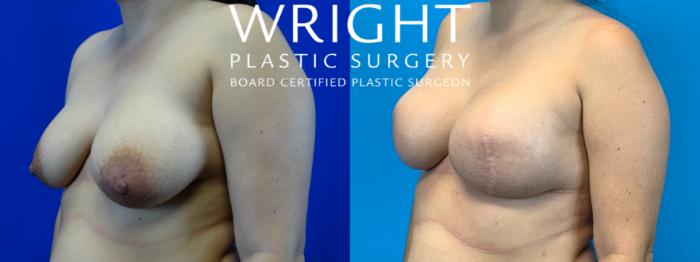 Before & After Breast Reconstruction Case 184 Left Oblique View in Little Rock, Arkansas