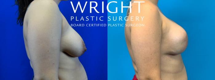 Before & After Breast Reconstruction Case 184 Right Side View in Little Rock, Arkansas