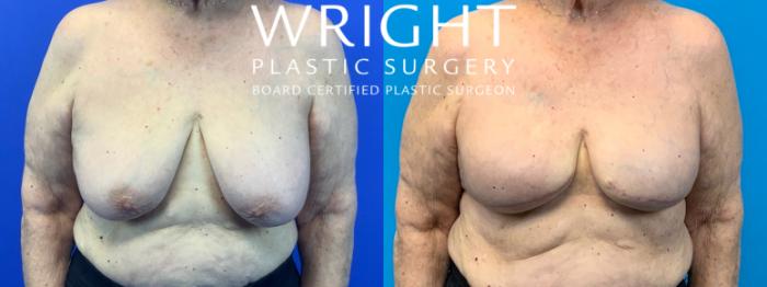 Before & After Breast Reconstruction Case 192 Front View in Little Rock, Arkansas